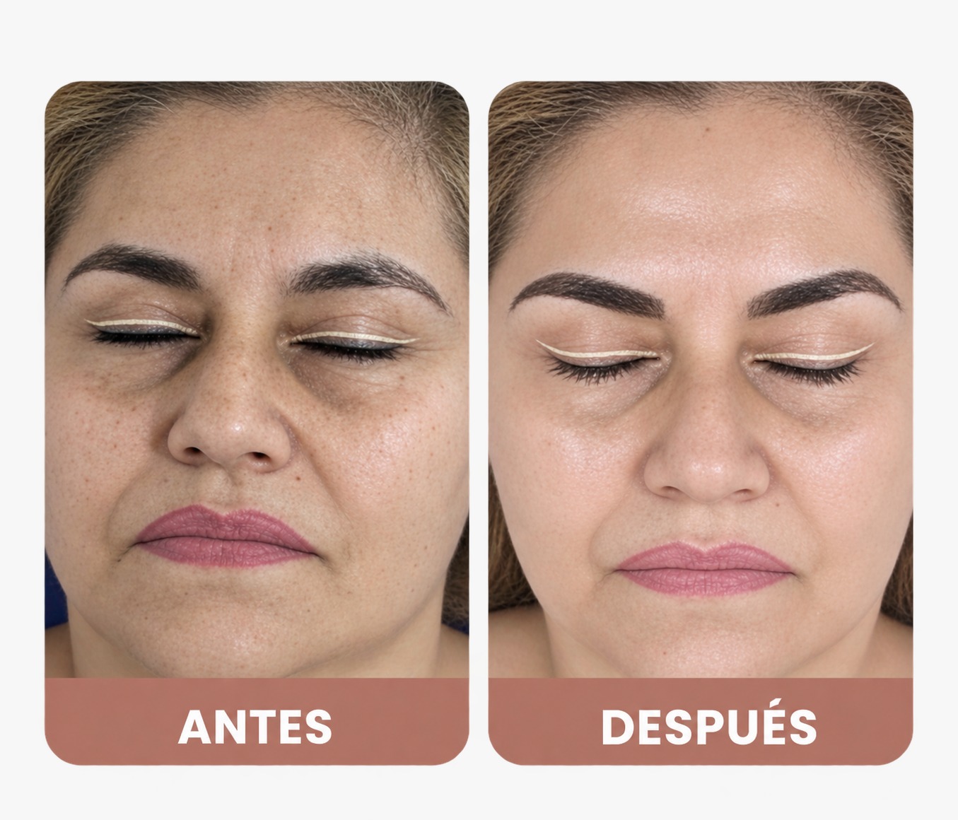 Antes y después de rejuvenecimiento facial